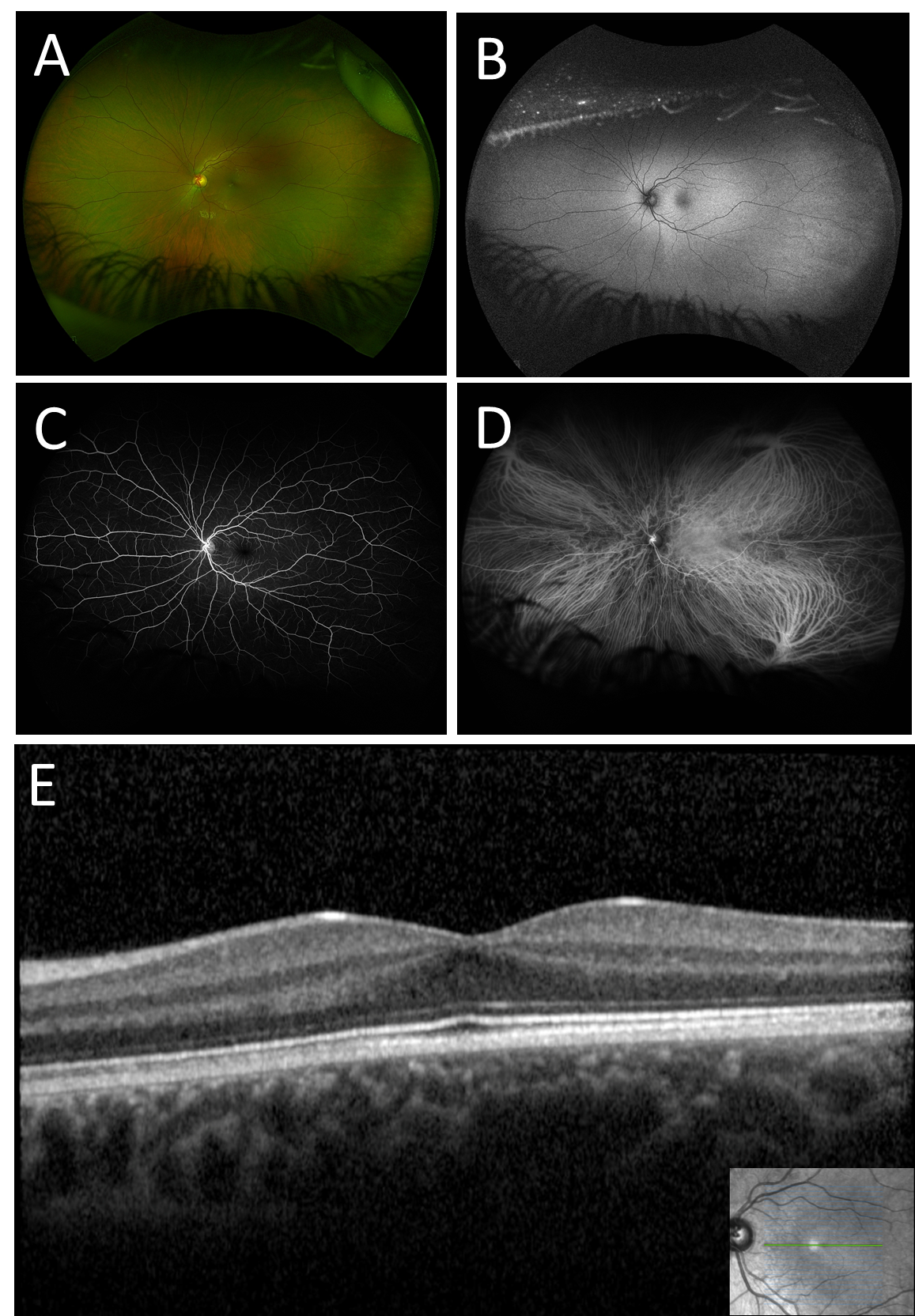 Multimodal Retinal Imaging Improves Diagnosis and Management